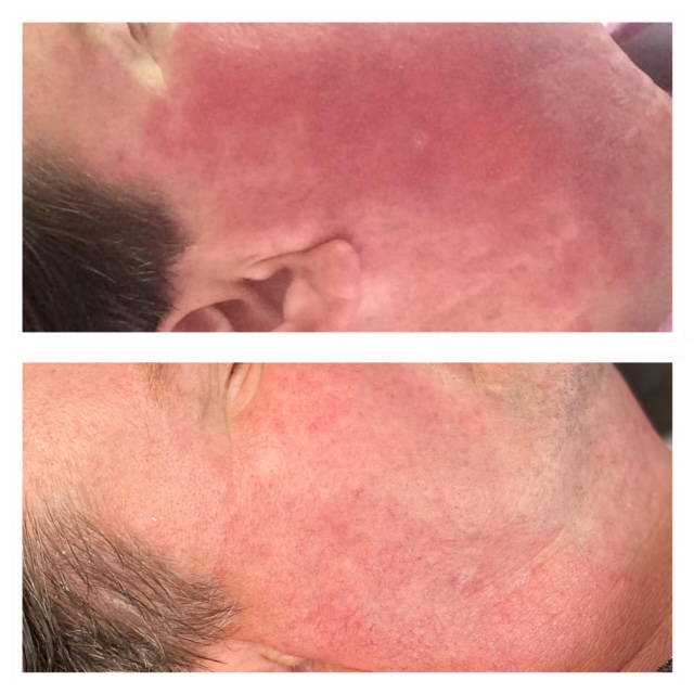 Before en after - Rosacea - IK Skin Perfection